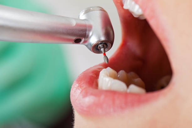 Best Emergency Dental Care for Broken or Chipped Teeth in Louisville, MS